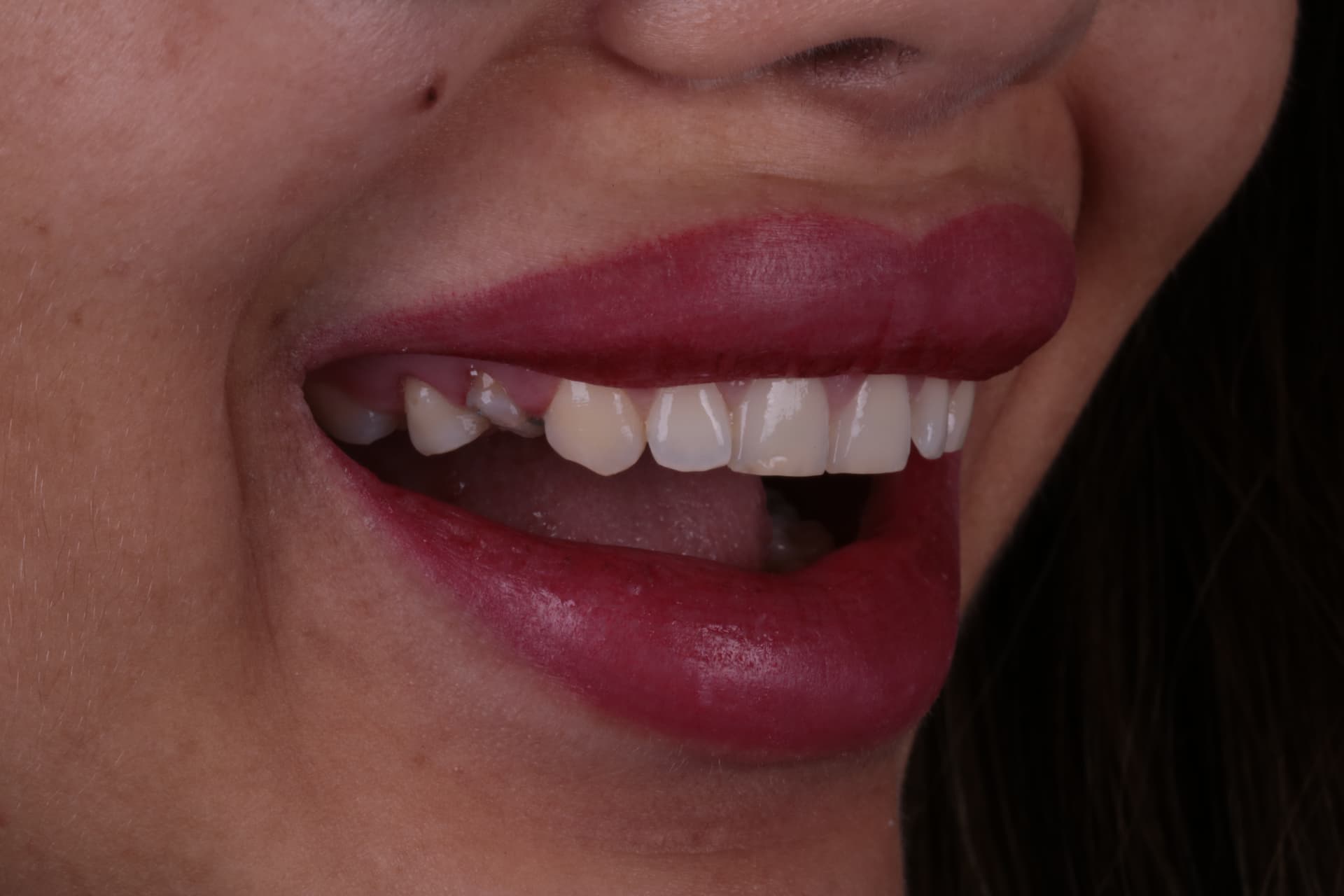 Antes: Caso de implante dentário e lentes de contato dental em Taubaté