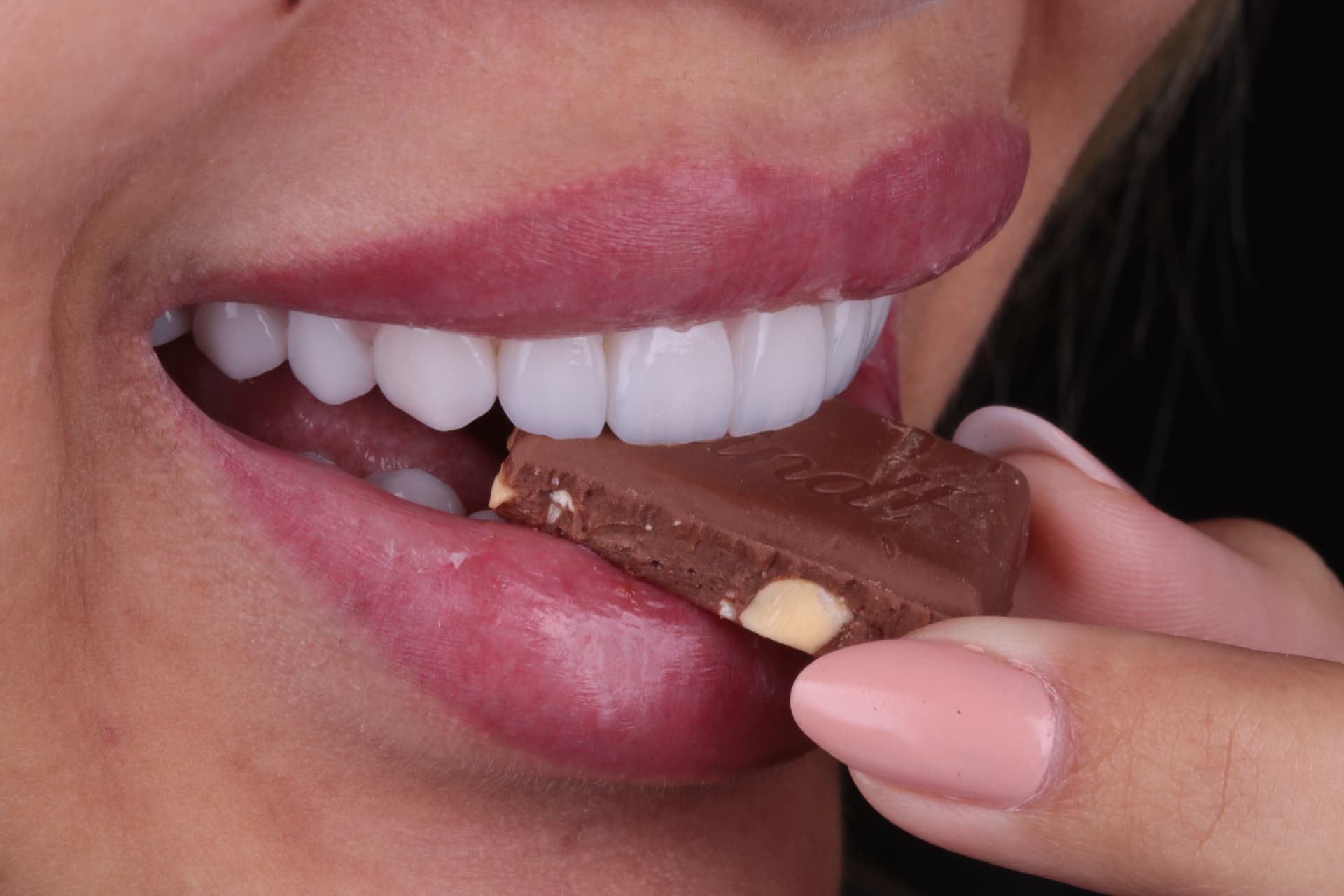 Depois: Caso de implante dentário e lentes de contato dental em Taubaté